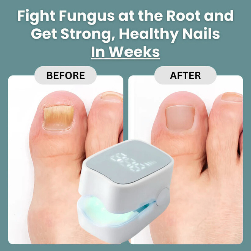 ExoraHub™ - Nail Fungus Laser Device
