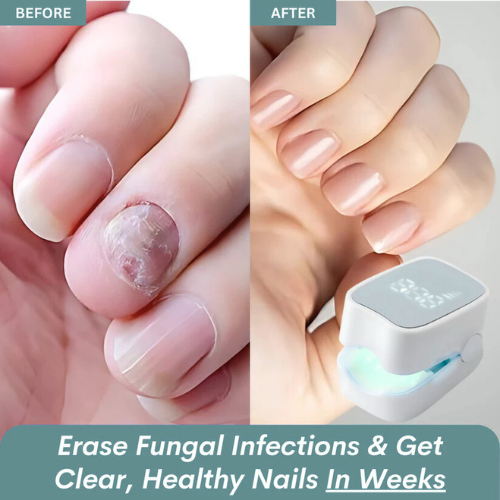 ExoraHub™ - Nail Fungus Laser Device