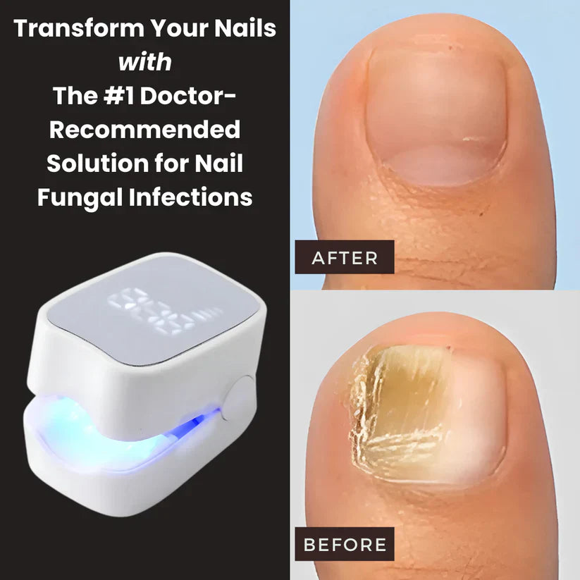 ExoraHub™ - Nail Fungus Laser Device